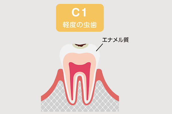 虫歯c1のイメージ