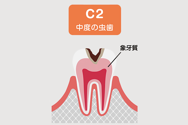 虫歯c2のイメージ