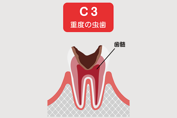 虫歯c3のイメージ