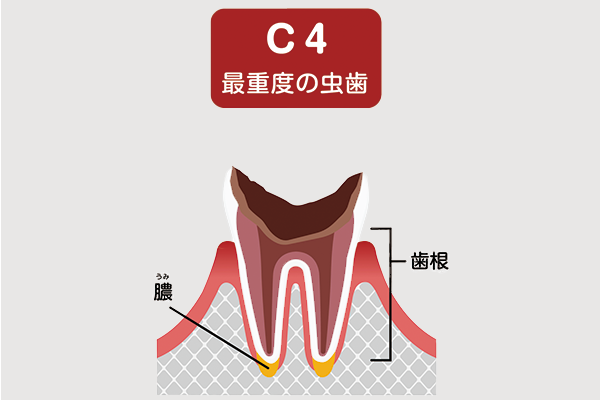 虫歯c4のイメージ