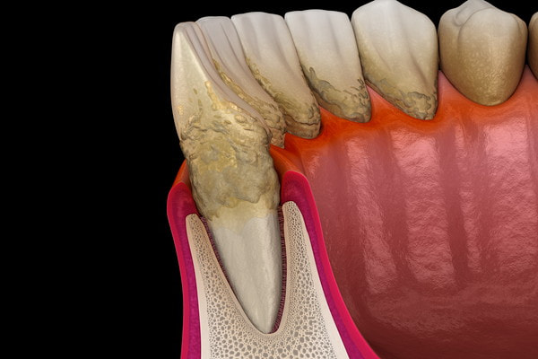 歯根の汚れのイメージ